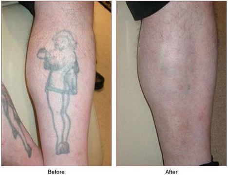 How Laser Tattoo Removal Works Learn Laser Tattoo Removal